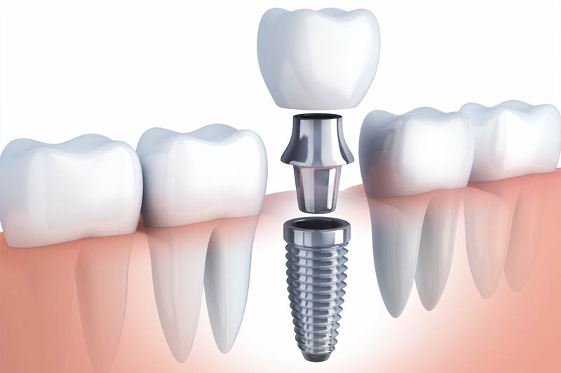 Implants Dentist in Van Nuys