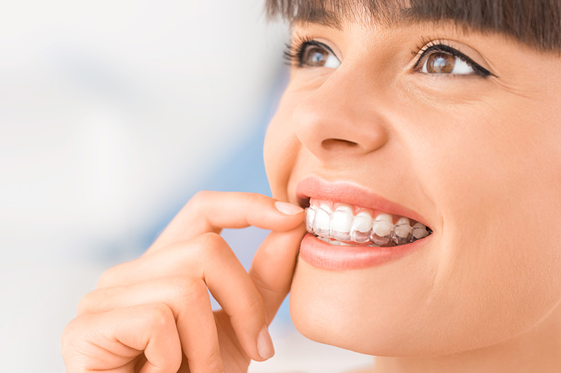 Invisalign Clear Aligners in 