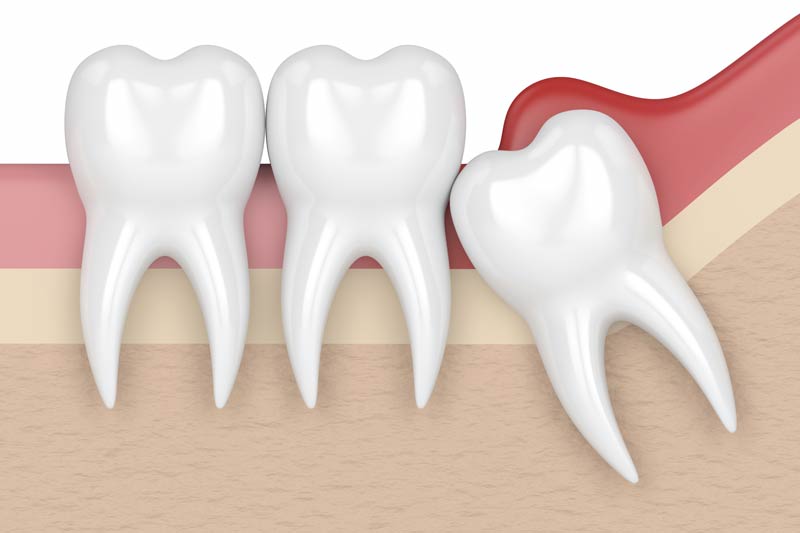 Wisdom Tooth Removal in Van Nuys